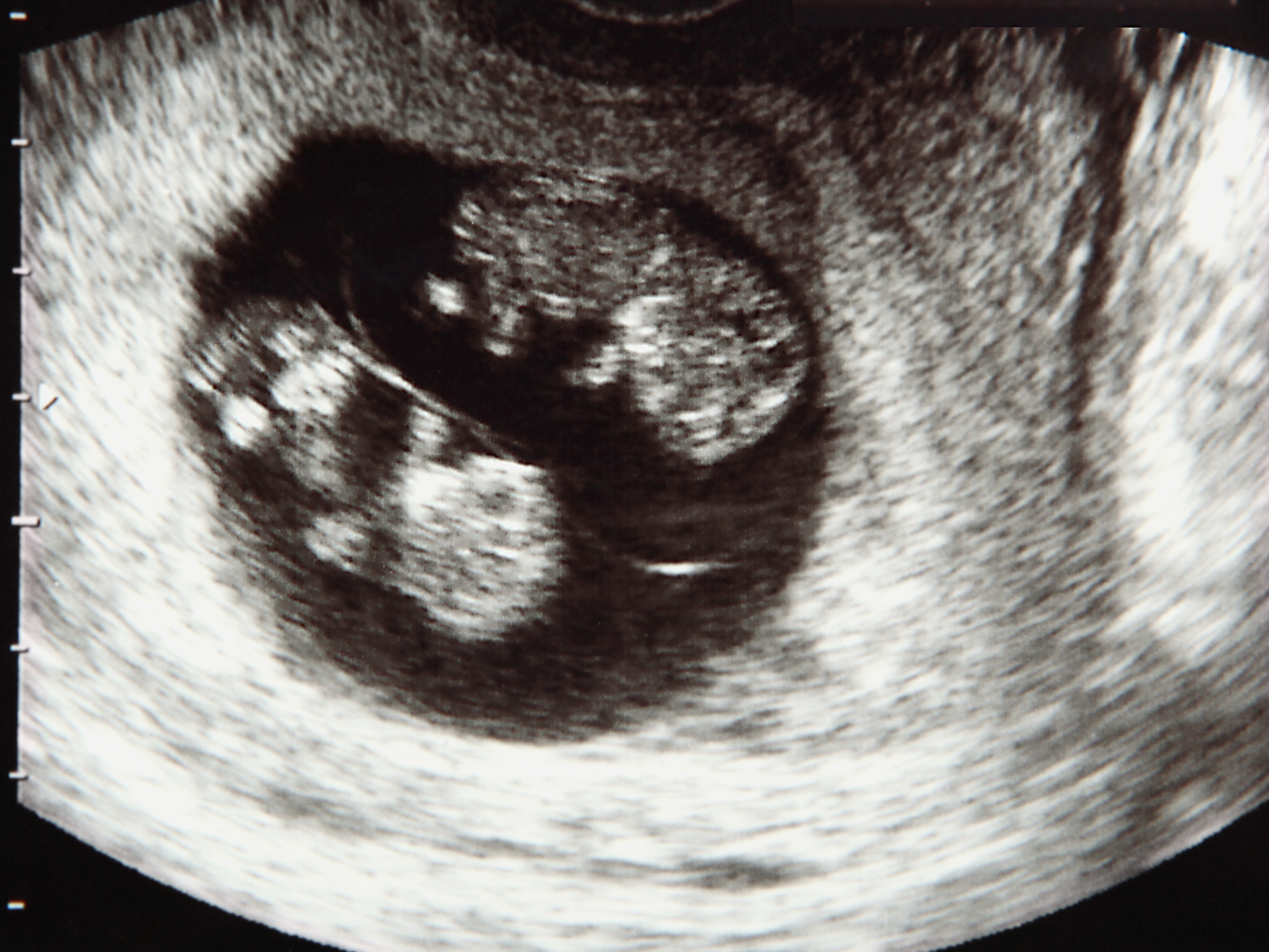 Parents choose life for unborn baby after being urged by doctors to abort twin