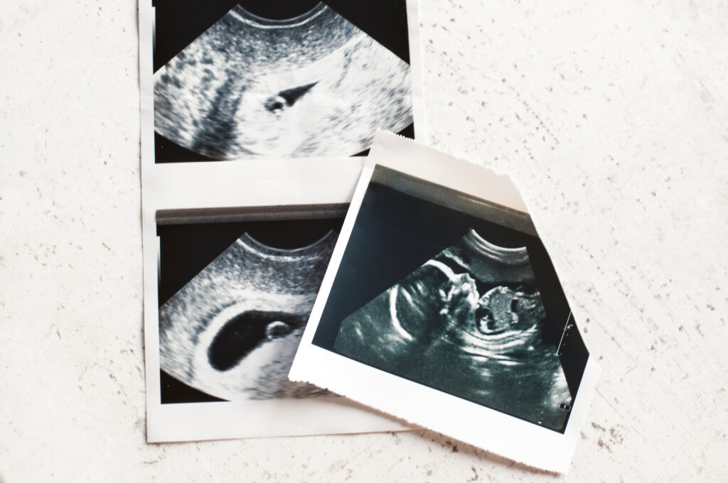 Photographs of pregnancy ultrasounds